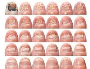 Gradual damage to the nail with a fungus