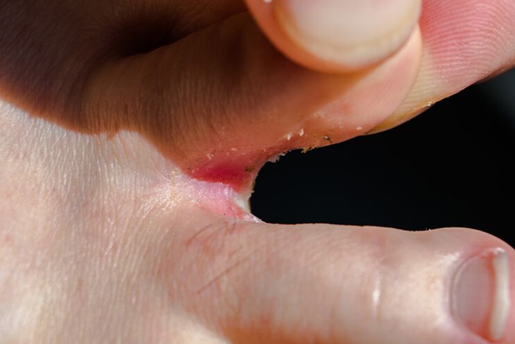 Tricofitosis