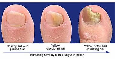 The manifestation of nail fungus