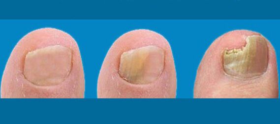 Nail fungus stages