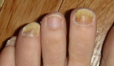 The causes of the appearance of the fungus on the nails