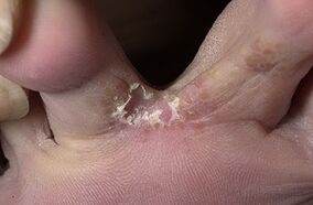 Girbok between the fingers