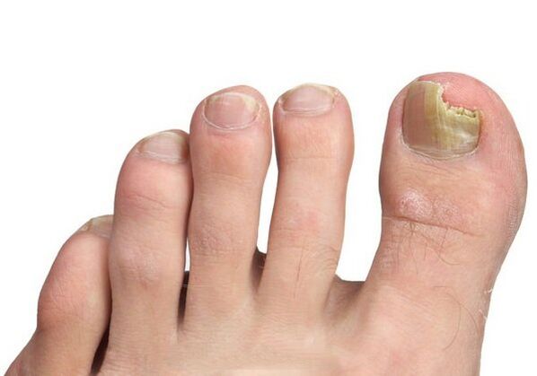 Causes of nail fungus