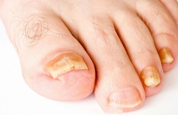 Nail fungus shapes
