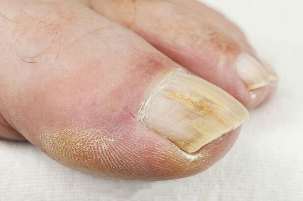 The consequences of fungal lesions