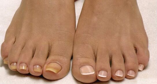 normal nails and nail fungus