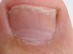 photo of the initial stage of nail fungus