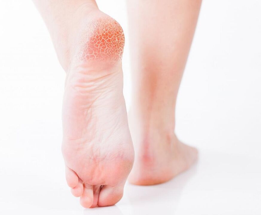 fungal infection in the foot