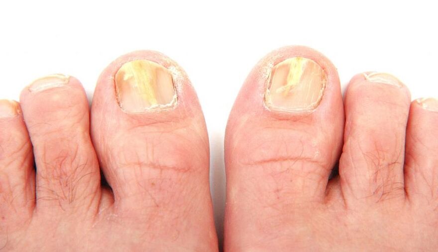 toenail fungus