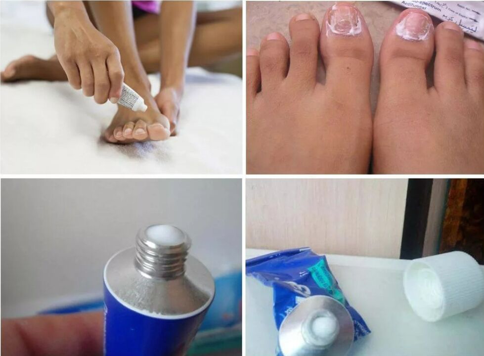 nail fungus remedy