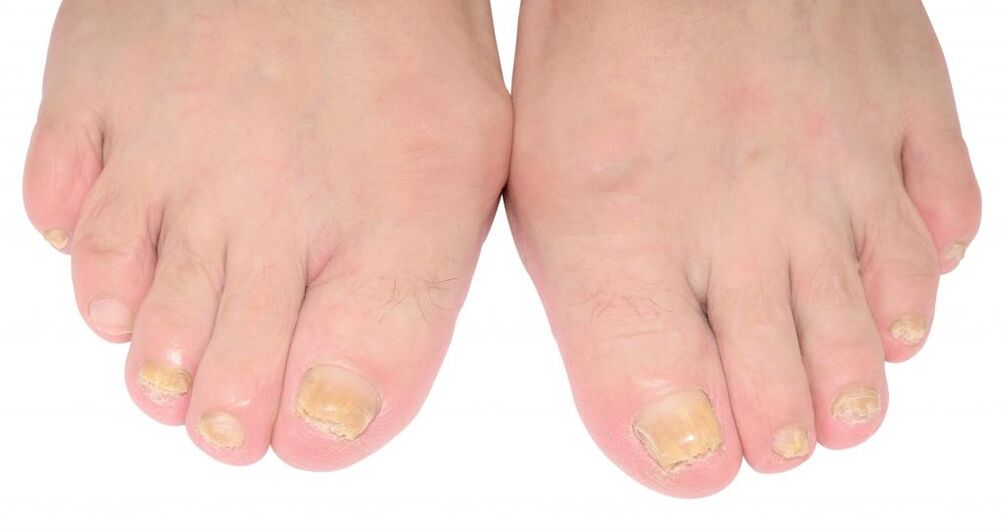signs of nail fungus