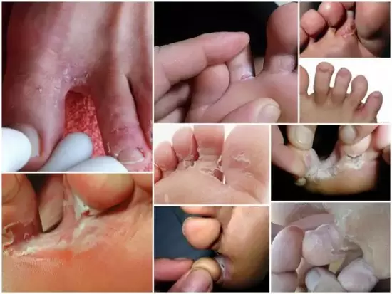 fungus symptoms between toes photo 2