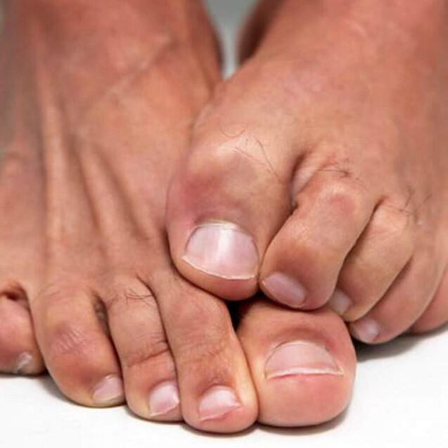 Foot fungus can cause itching