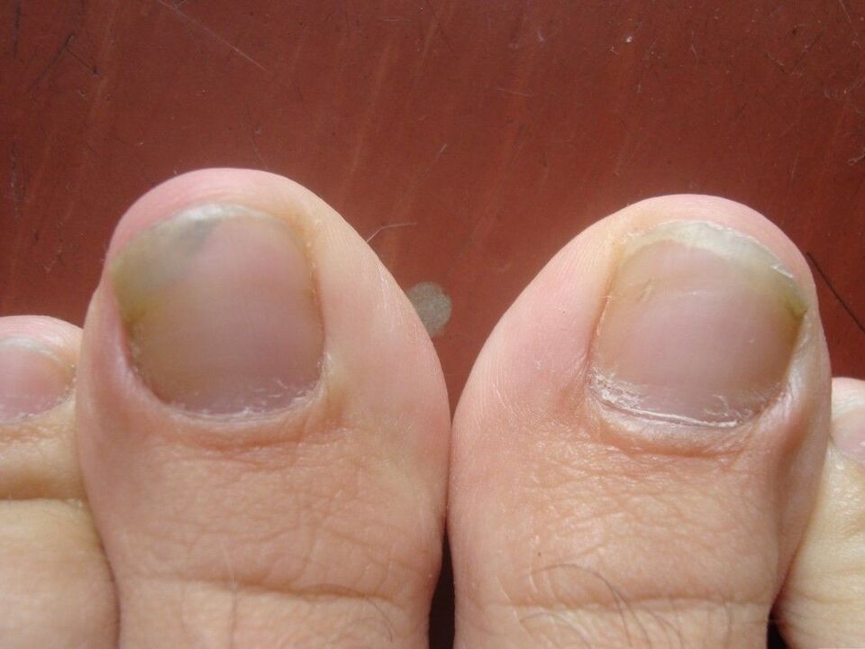 nail fungus symptoms and causes