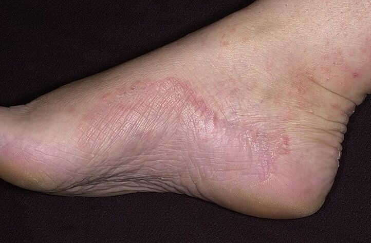 Foot fungus infection