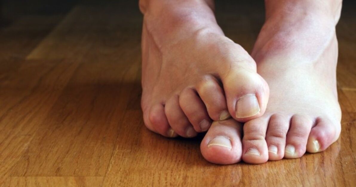 fungus symptoms between toes