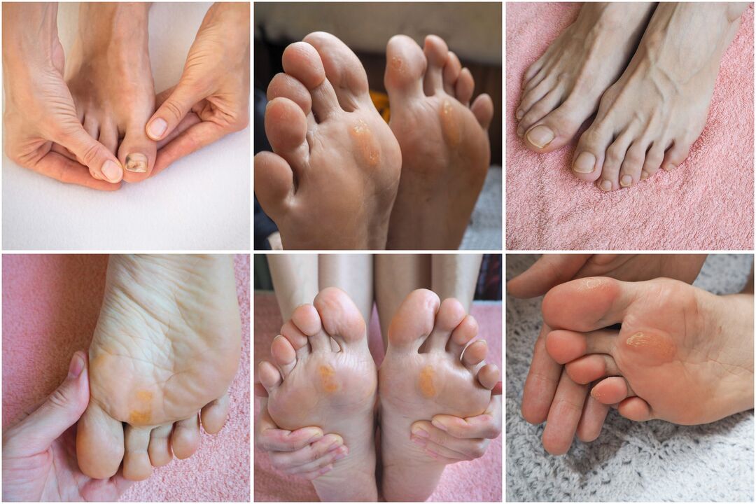 types of foot fungus
